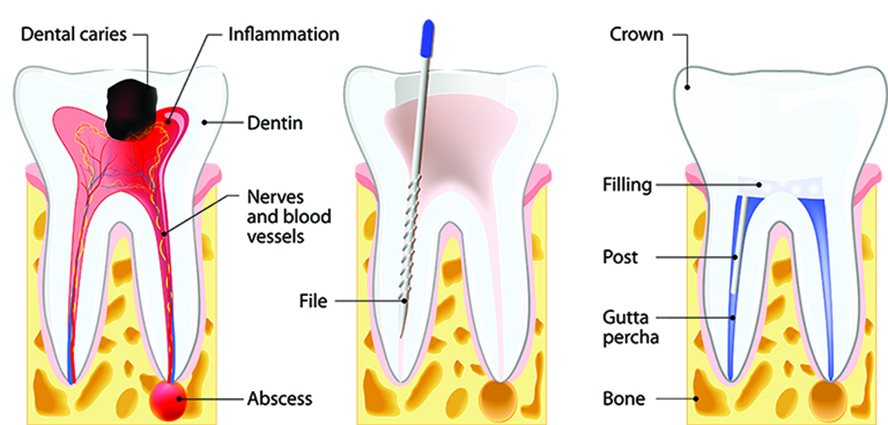 Root Canal Treatment