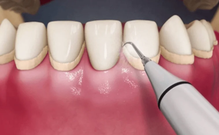 Ultrasonic Scaling